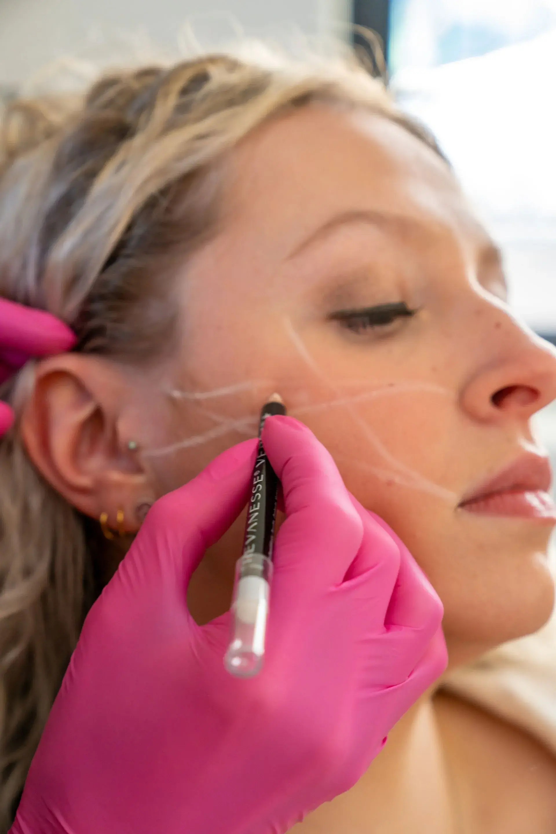 Close-up of a precise volume restoration treatment at Illume Aesthetics in Cottleville, Missouri
